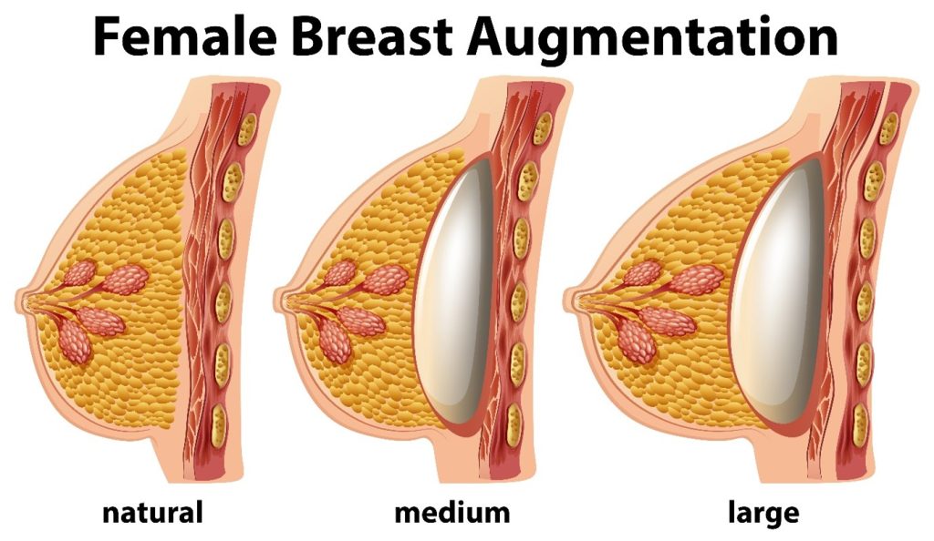 breast augmentation Malaysia