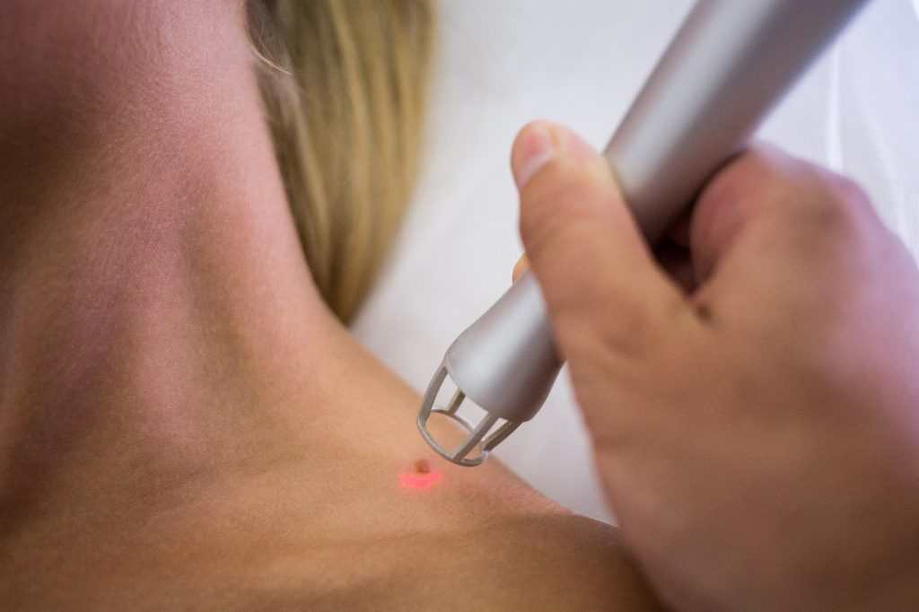 Keloid Laser treatment