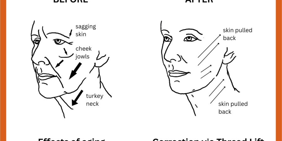 1774885064 diagram showing before and after of a thread lift procedure on female patient 900x450
