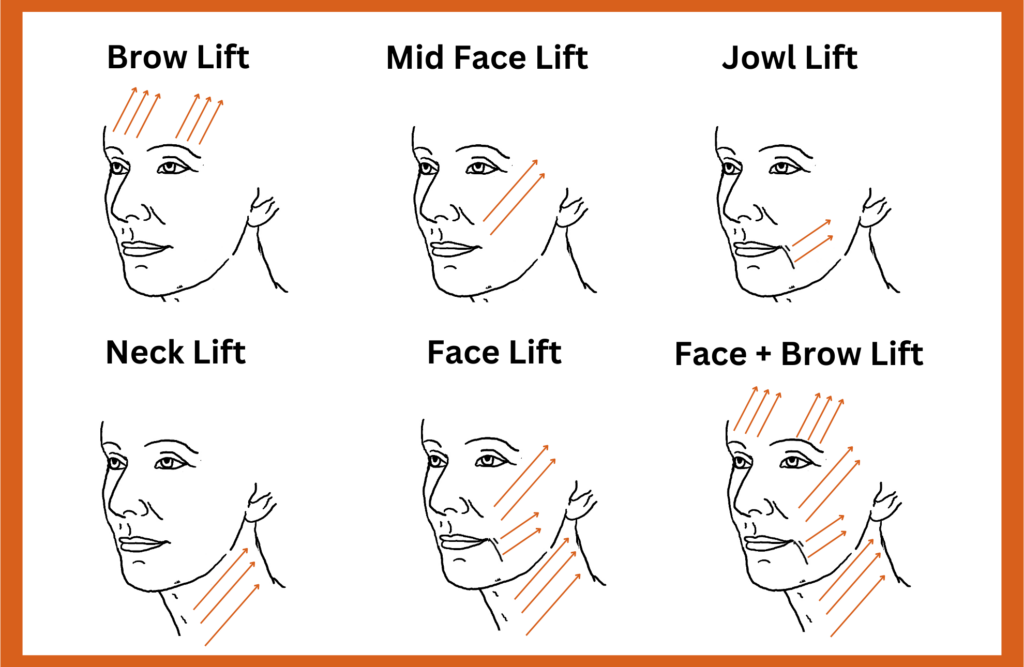 1774885123 digrams of various types of thread lifts on different parts of the face including brows neck and jowls 1024x667