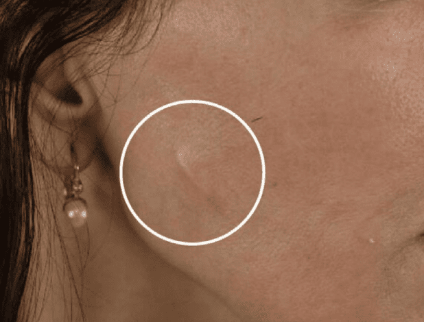 1774885159 thread lift with visible thread on skin surface