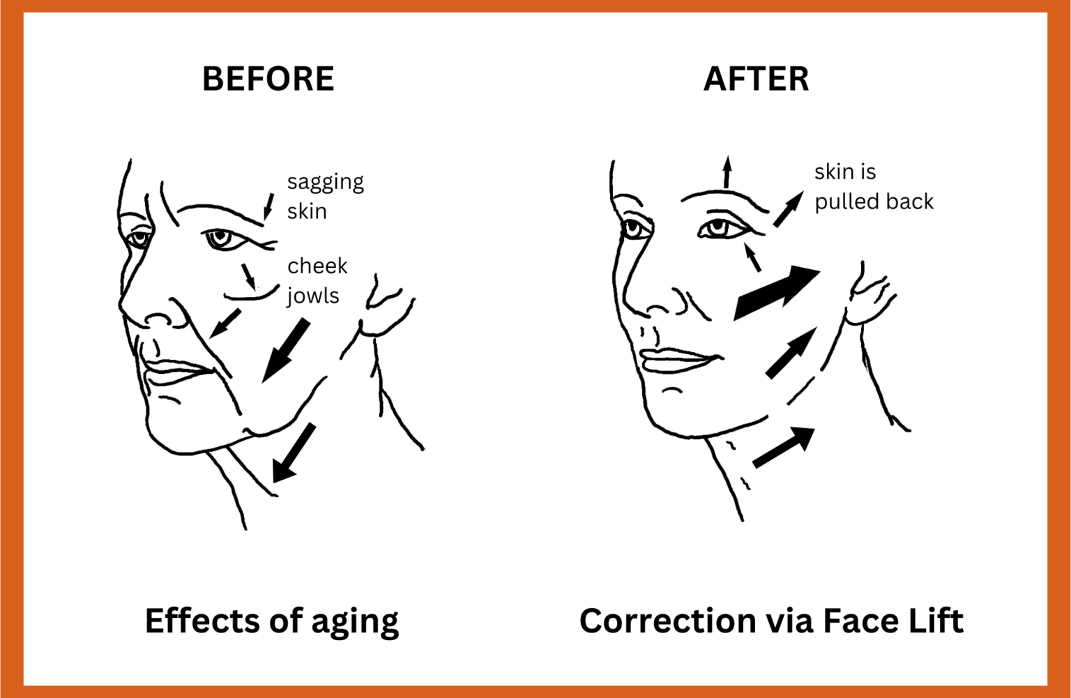 1778066142 diagram showing before and after of facelift on cheeks neck and forehead 1536x1001