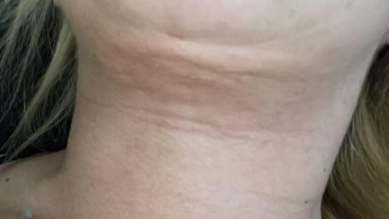 1778067730 chin liposuction recovery period 768x432
