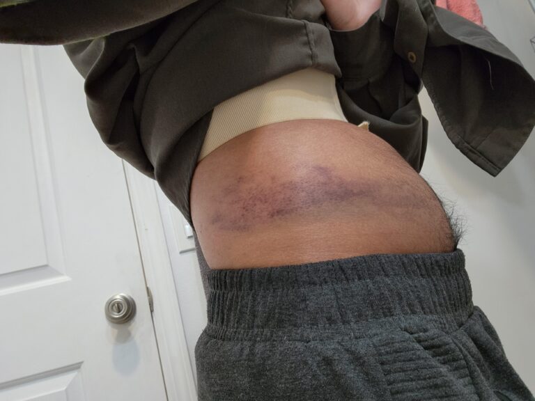 1778072832 slight bloating and bruising on stomach post liposuction 768x576