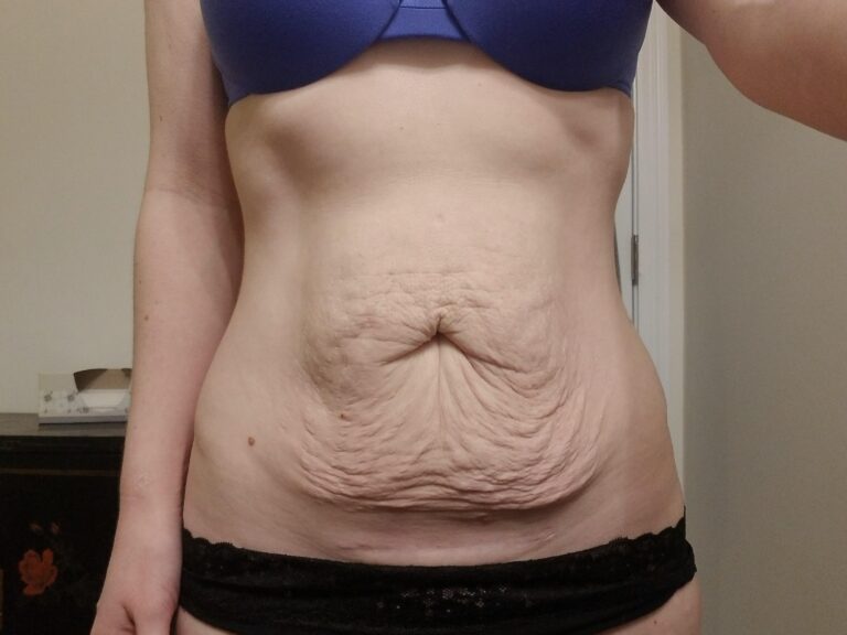 1778073225 picture of stomach with loose skin after drastic weight loss in the abdominal area 768x576