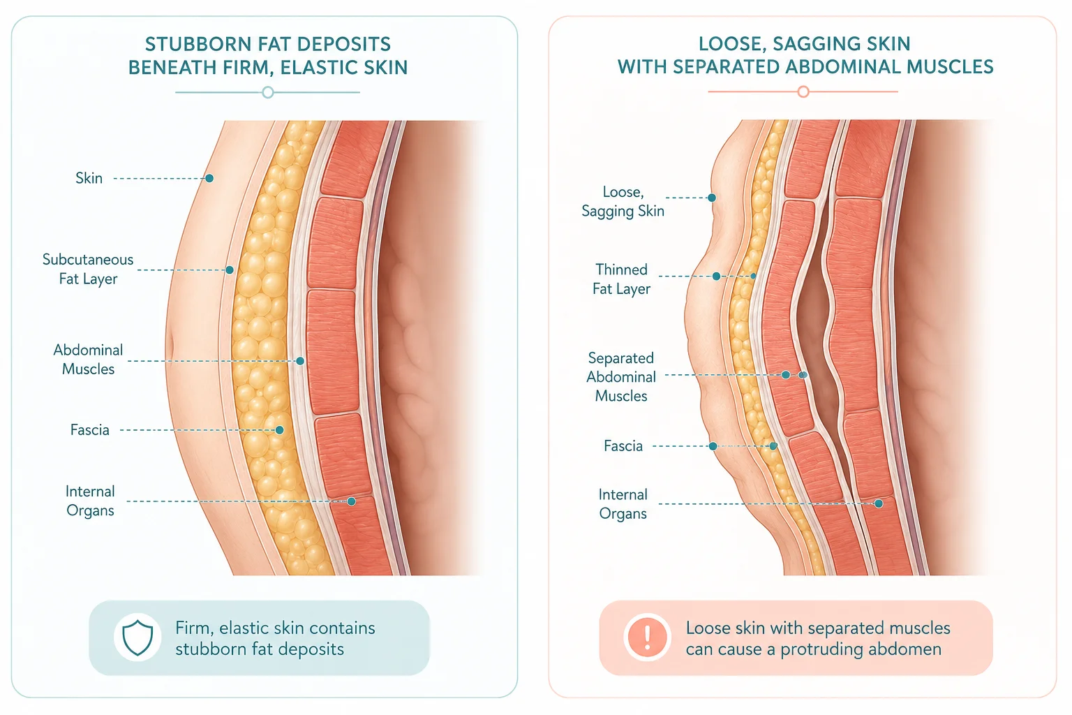 Difference between liposuction fat removal and tummy tuck loose skin repair abdomen