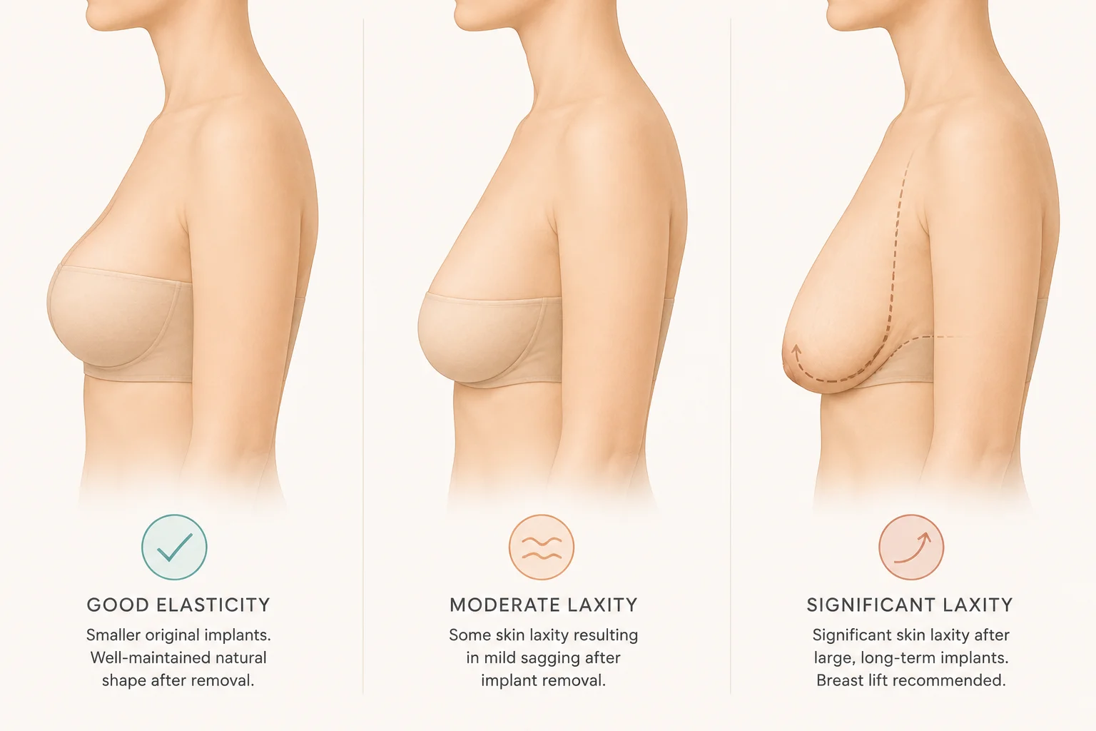 Breast shape after implant removal outcomes skin elasticity natural tissue what to expect